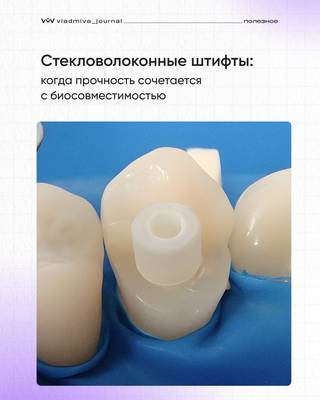 Стекловолоконные штифты: биомиметика в эндодонтии.
